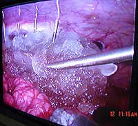 Doctors use an endoscope to see the application of the slurry during a laparoscopic kidney surgery on a pig